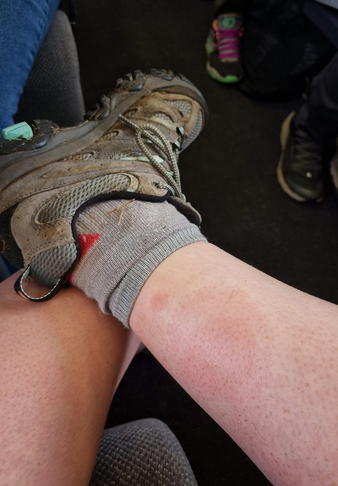 Big bite on swollen ankle